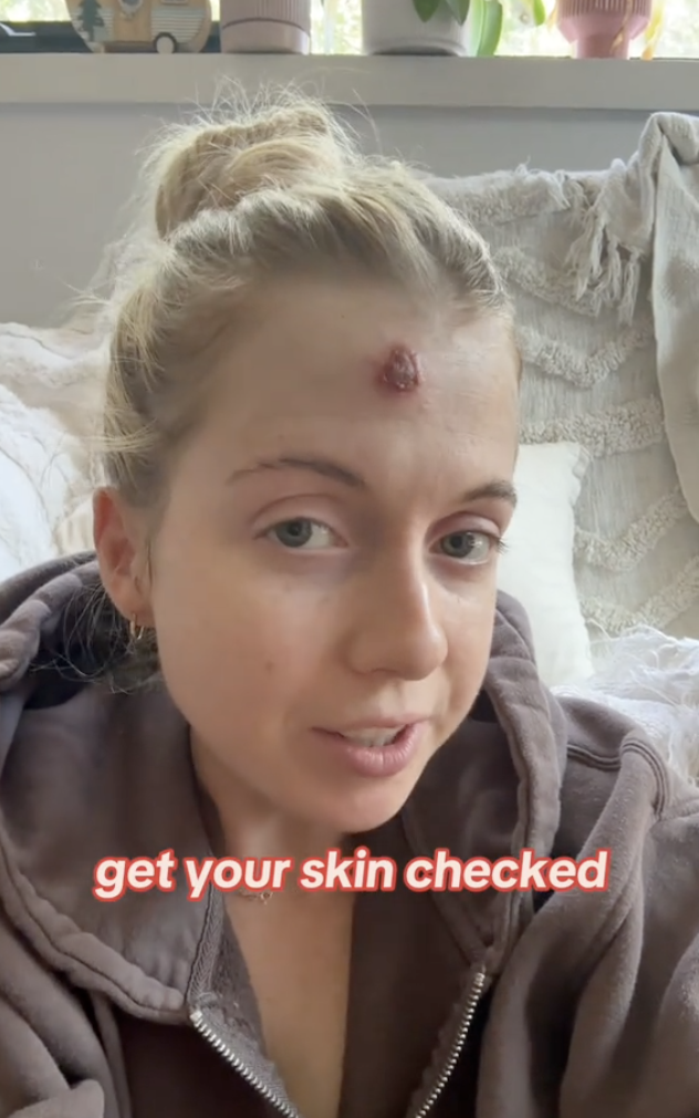 tik tok user with skin cancer